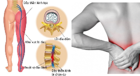 phục cốt hoàn trị thoát vị đĩa đệm